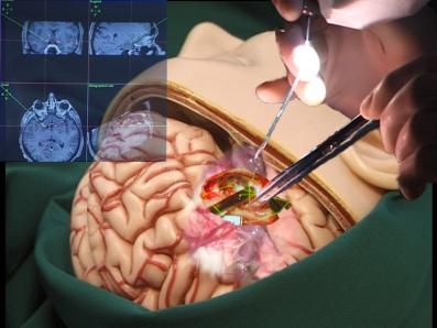Thema Gehirntumor Thema Gehirntumor